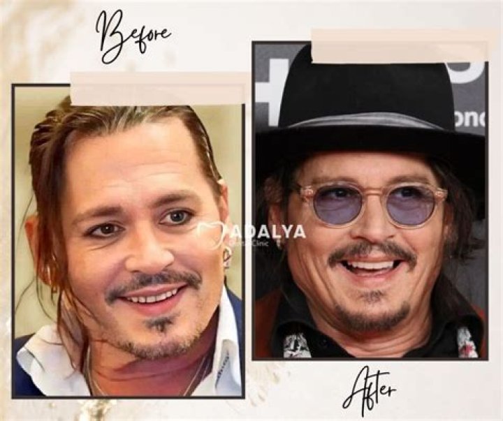 Johnny Depp’s teeth “rotting” due to wear & tear, says celebrity dentist Dr. Apa.